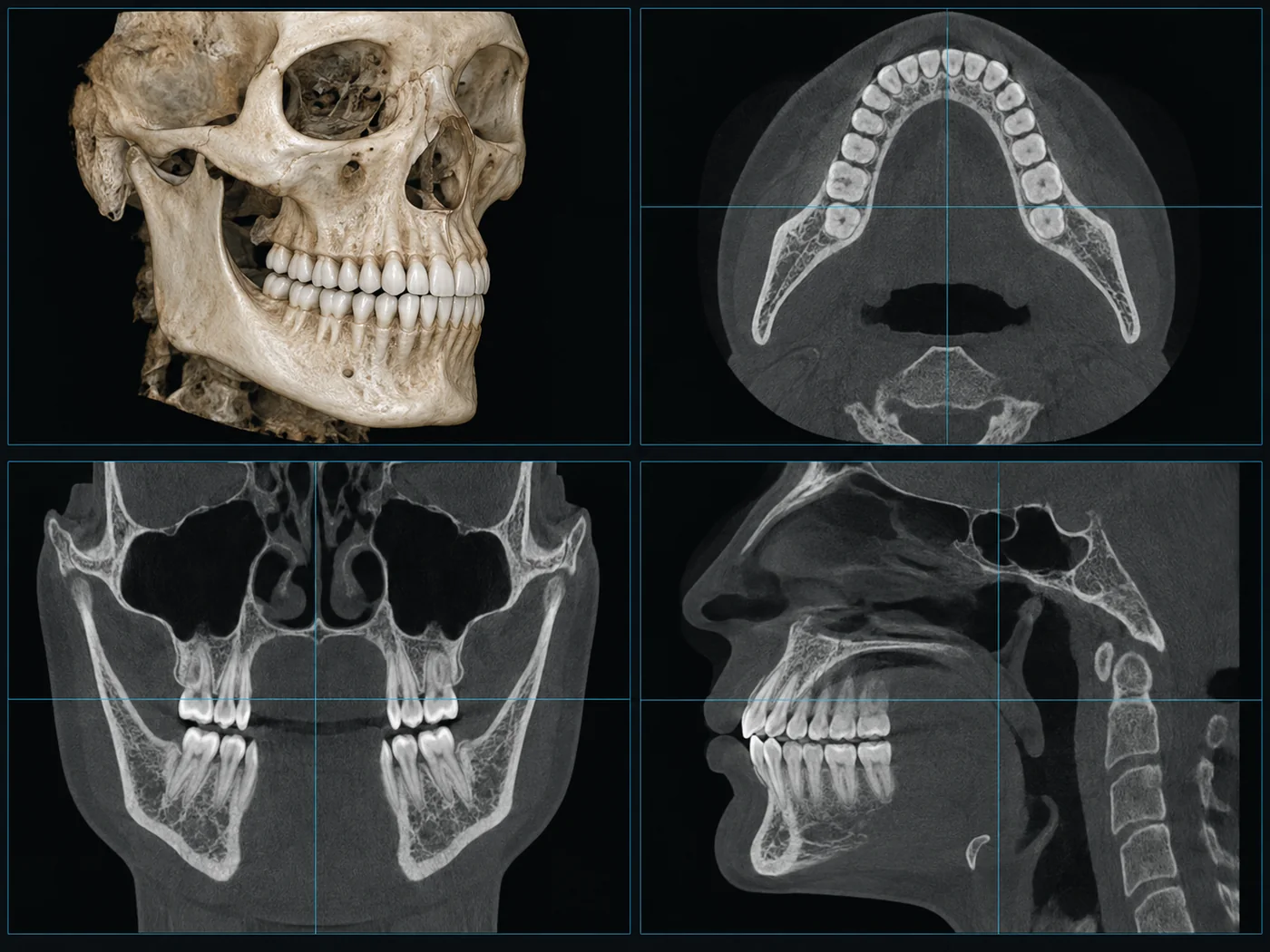 CBCT dental scan views showing three-dimensional jaw and tooth imaging