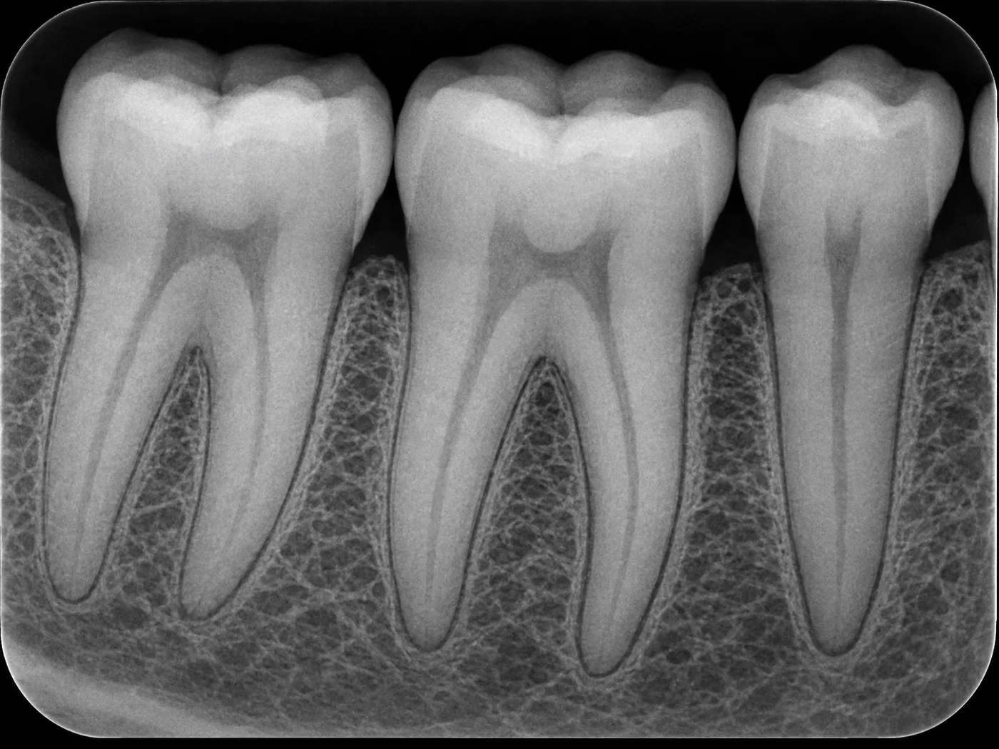 Intraoral periapical dental X-ray showing individual teeth and roots